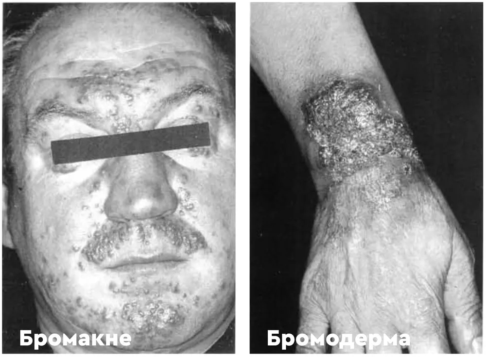 Проявления дерматологических эффектов